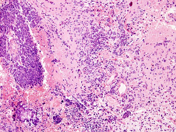 4A1 Medullomyoblastoma (Case 4) H&E 1A