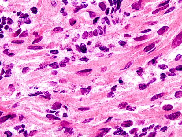 4A10 Medullomyoblastoma (Case 4) H&E 10A