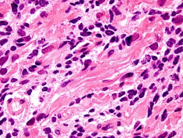 4A11 Medullomyoblastoma (Case 4) H&E 14A