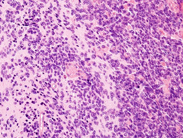 4A2 Medullomyoblastoma (Case 4) H&E 15A