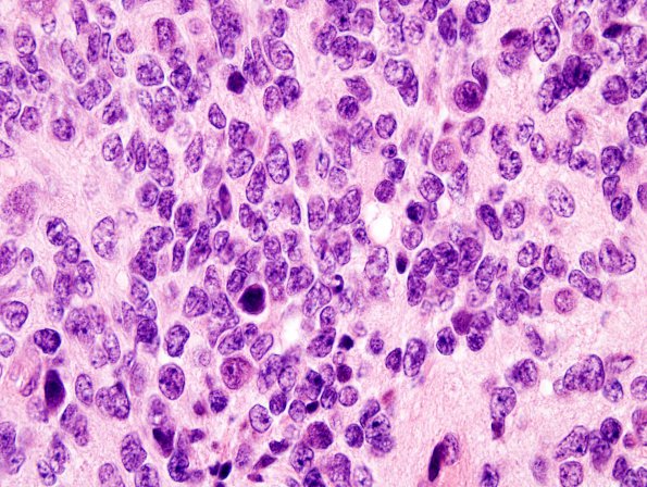 4A3 Medullomyoblastoma (Case 4) H&E 11A