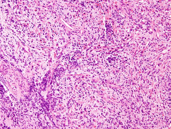 4A4 Medullomyoblastoma (Case 4) H&E 2A