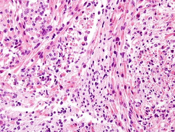 4A5 Medullomyoblastoma (Case 4) H&E 5A