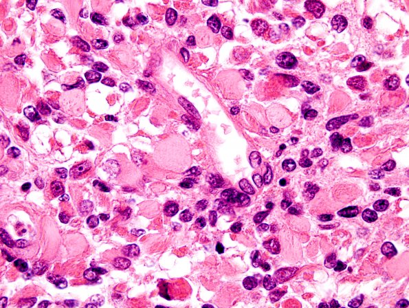 4A6 Medullomyoblastoma (Case 4) H&E 13A