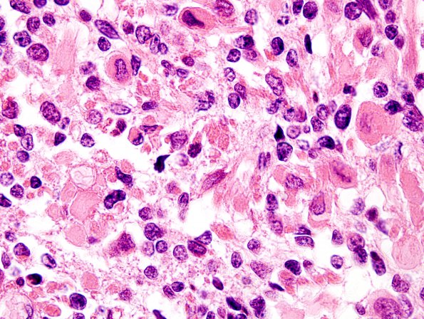 4A7 Medullomyoblastoma (Case 4) H&E 6A