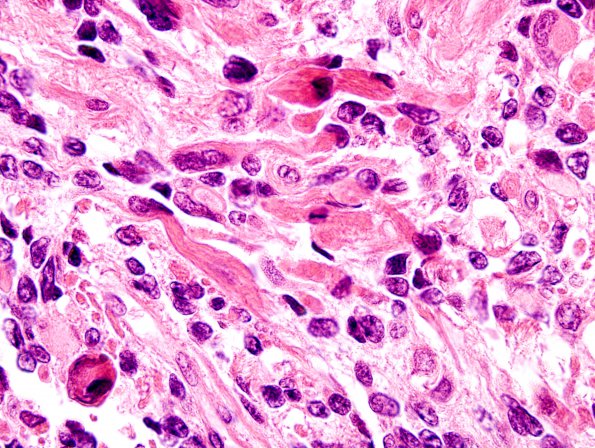 4A8 Medullomyoblastoma (Case 4) H&E 7A