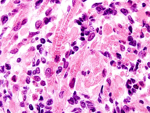 4A9 Medullomyoblastoma (Case 4) H&E 8A