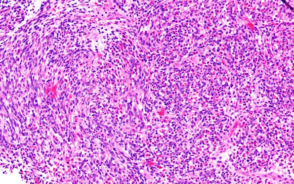 5A1 Medullomyoblastoma (W21-2112) H&E 20X