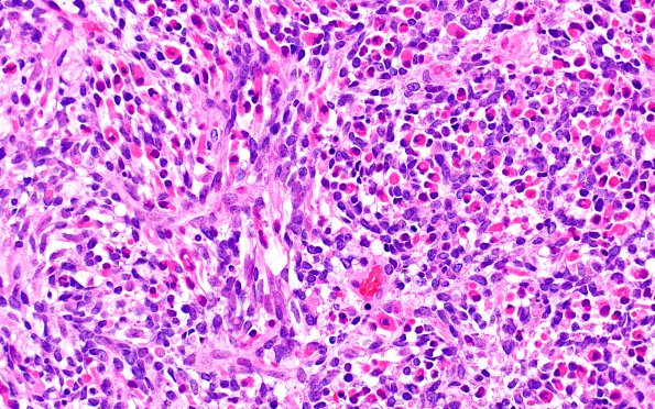 5A2 Medullomyoblastoma (Case 5) H&E 40X