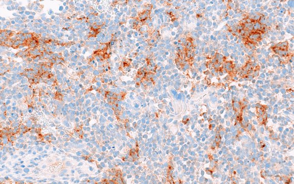 5B1 Medullomyoblastoma (Case 5) SYN 40X 2