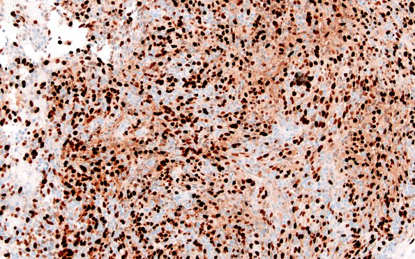 5G1 Medullomyoblastoma (Case 5) Myogenin 20X 2