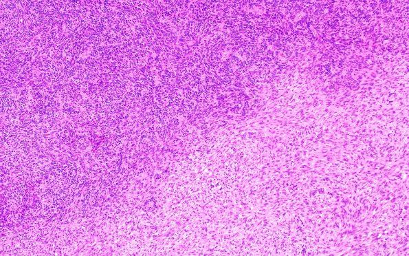 6A1 Medullomyoblastoma (Case 6) H&E 10X