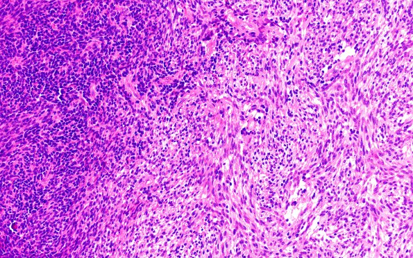 6A2 Medullomyoblastoma (Case 6) H&E 20X 2