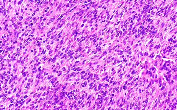 6A4 Medullomyoblastoma (Case 6) H&E 40X 5