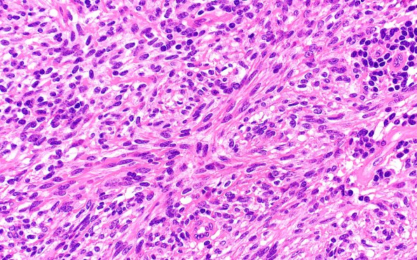 6A5 Medullomyoblastoma (Case 6) H&E 40X 1