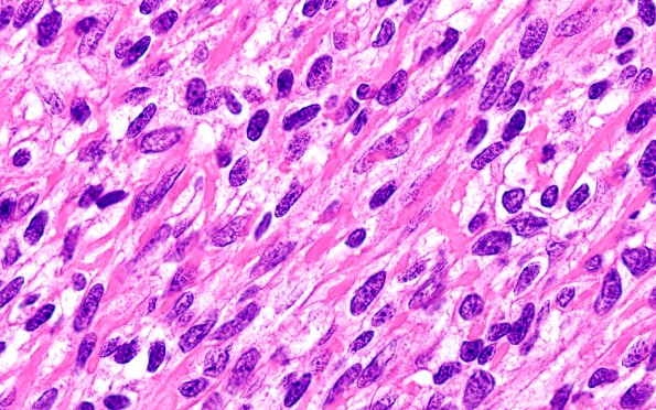 6A6 Medullomyoblastoma (Case 6) H&E 100X1