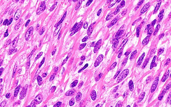 6A7 Medullomyoblastoma (Case 6) H&E 100X2