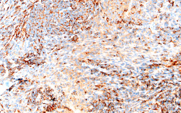 6B Medullomyoblastoma (Case 6) SYN 20X