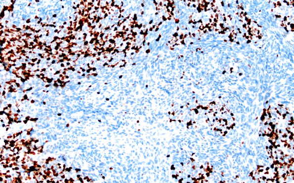 6C Medullomyoblastoma (Case 6) Ki67 20X 3