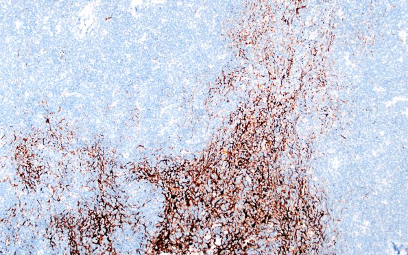 6D1 Medullomyoblastoma (Case 6) Desmin 10X 2