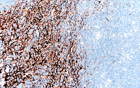 6D2 Medullomyoblastoma (Case 6) Desmin 20X 2