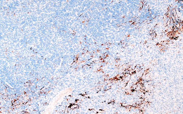 6D3 Medullomyoblastoma (Case 6) Desmin 10x 3