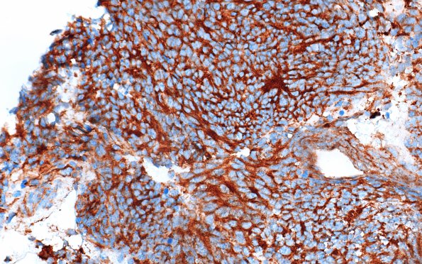 7B MedMyoB (Case 7) Beta catenin 1