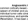 0A1 Angiocentric Glioma - Text