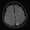 1A1 Angiocentric glioma (Case 1) FLAIR 1 - Copy copy