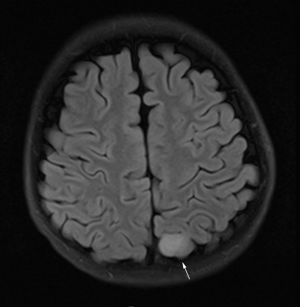 1A1 Angiocentric glioma (Case 1) FLAIR 1 - Copy copy