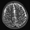 1A2 Angiocentric glioma (Case 1) T2W 1 - Copy copy