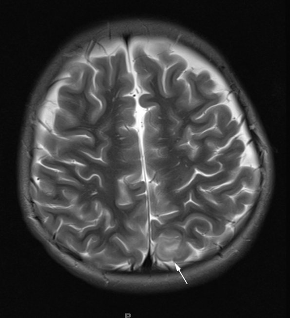 1A2 Angiocentric glioma (Case 1) T2W 1 - Copy copy