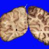 1B1 Angiocentric Glioma (Case 1) 3 copy