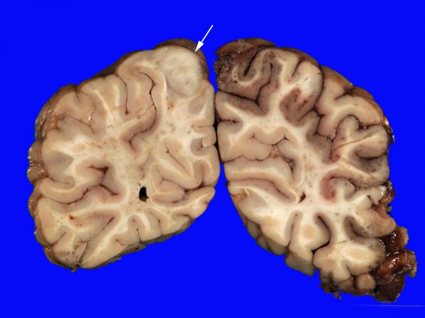 1B1 Angiocentric Glioma (Case 1) 3 copy