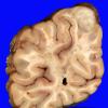 Angiocentric glioma