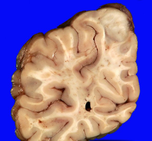 1B2 Angiocentric Glioma (Case 1) 1