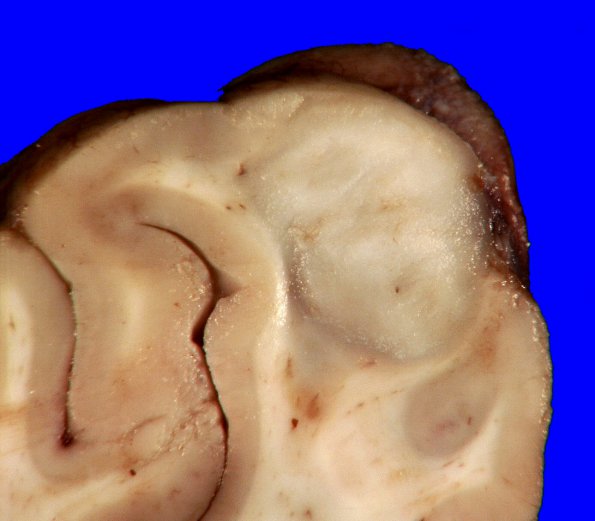 1B3 Angiocentric Glioma (Case 1) 2