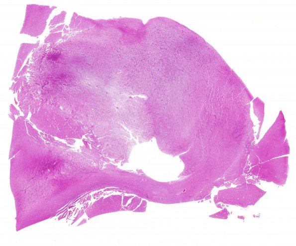 1C1 Angiocentric Glioma (Case 1) H&E whole mount