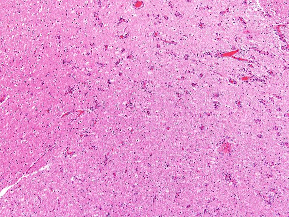 1C10 Angiocentric Glioma (Case 1) H&E 3