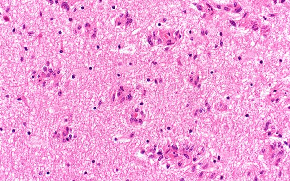 1C11 Angiocentric Glioma (Case 1) H&E 40X3