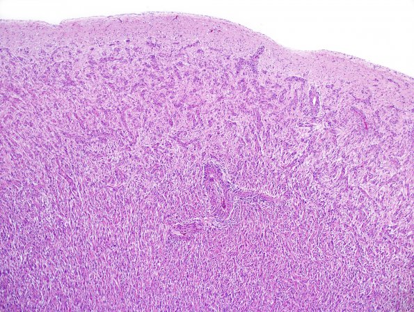 1C2 Angiocentric Glioma (Case 1) N18 H&E 10X 3