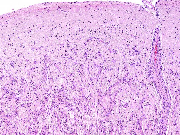 1C3 Angiocentric Glioma (Case 1) N18 H&E 10X 2