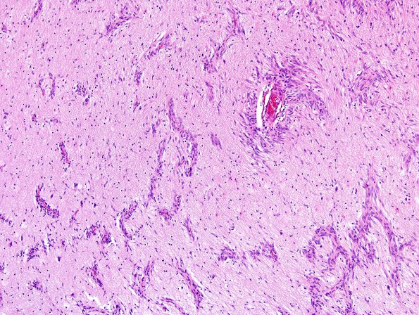 1C4 Angiocentric Glioma (Case 1) N18 H&E 10X 1