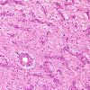 1C5 Angiocentric Glioma (Case 1) H&E 12