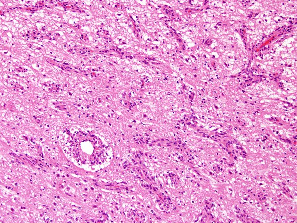 1C5 Angiocentric Glioma (Case 1) H&E 12