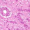 1C6 Angiocentric Glioma (Case 1) H&E 13.