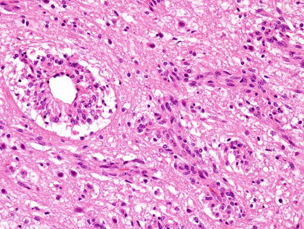 1C6 Angiocentric Glioma (Case 1) H&E 13.