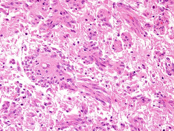 1C7 Angiocentric Glioma (Case 1) H&E 17.