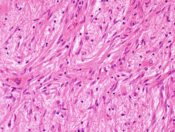 1C8 Angiocentric Glioma (Case 1) H&E 7