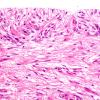 1C9 Angiocentric Glioma (Case 1) H&E 15